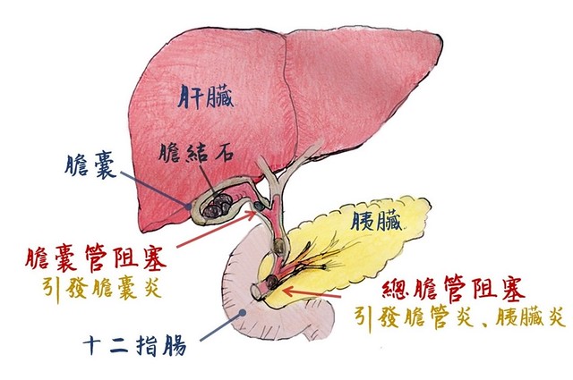 膽結石示意圖